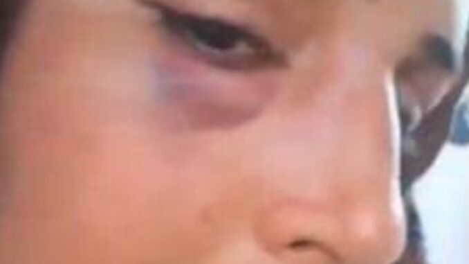 Seema Haider Assaulted: Viral Video Shows Bruised Lip and Eye – What Happened?